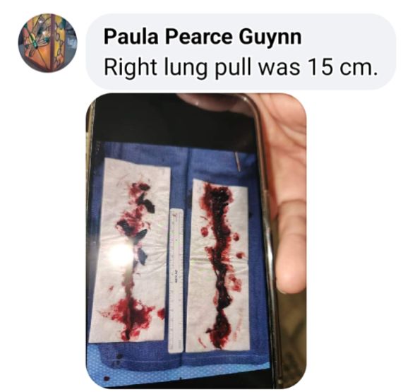 Florida, Paula Pearce Guynn.

“Very long read & graphic photo in the comments. Don't look if you're squeamish. 

They found numerous blood clots in the arteries of both lungs.

During surgery, they pulled 1 15cm blood clot plus numerous others.”

#vaccineinjury #bloodclot #pfizer
