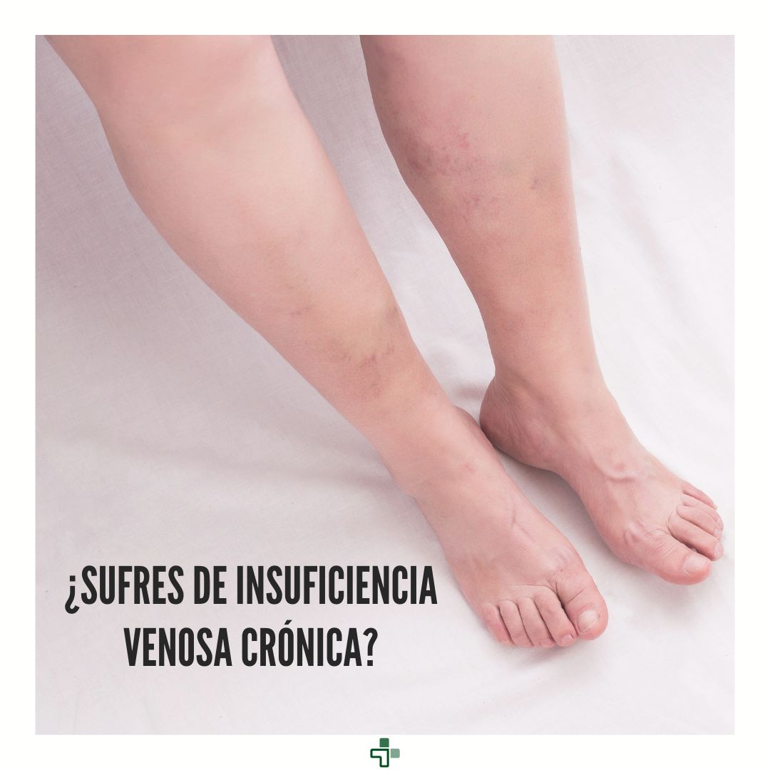 Mibotika's tweet photo. 🦵 La insuficiencia venosa crónica no es solo una cuestión estética, es sobre salud y bienestar. Tus piernas merecen el alivio y el soporte que los productos Varisan ofrecen.
 #CuidaTusPiernas #VarisanEnNuestraFarmacia #Mibotika https://t.co/Me0CZPRA7z