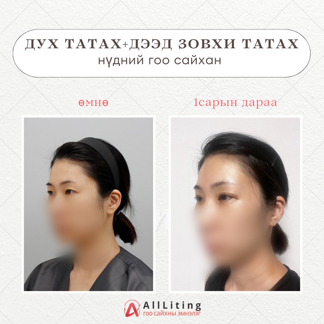 📷📷#ДУХ_ТАТАХ #ДЭЭД_ЗОВХИ_ТАТАХ📷📷 #БОДИТ_ҮР_ДҮН
хийсэн ажилбар:
📷Дух татах ажилбар
📷Дээд зовхи татах ажилбар
ALL LITING нүдний гоо сайхны мэс заслаар мэргэшсэн эмнэлэг.
-----------------------------
📷монгол ажилтан: 010-4931-4451