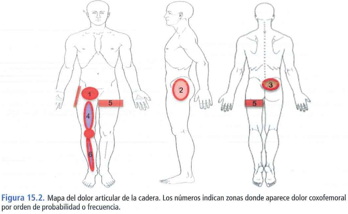 ¿CÓMO ES LA PRESENTACIÓN CLÍNICA DEL DOLOR DE CADERA?

Existen diferentes variables en el dolor, la localización y la discapacidad de un paciente con patología articular de cadera.

Aunque el síntoma más frecuente es el dolor inguinal, existen otras localizaciones.

🧵👇🏻