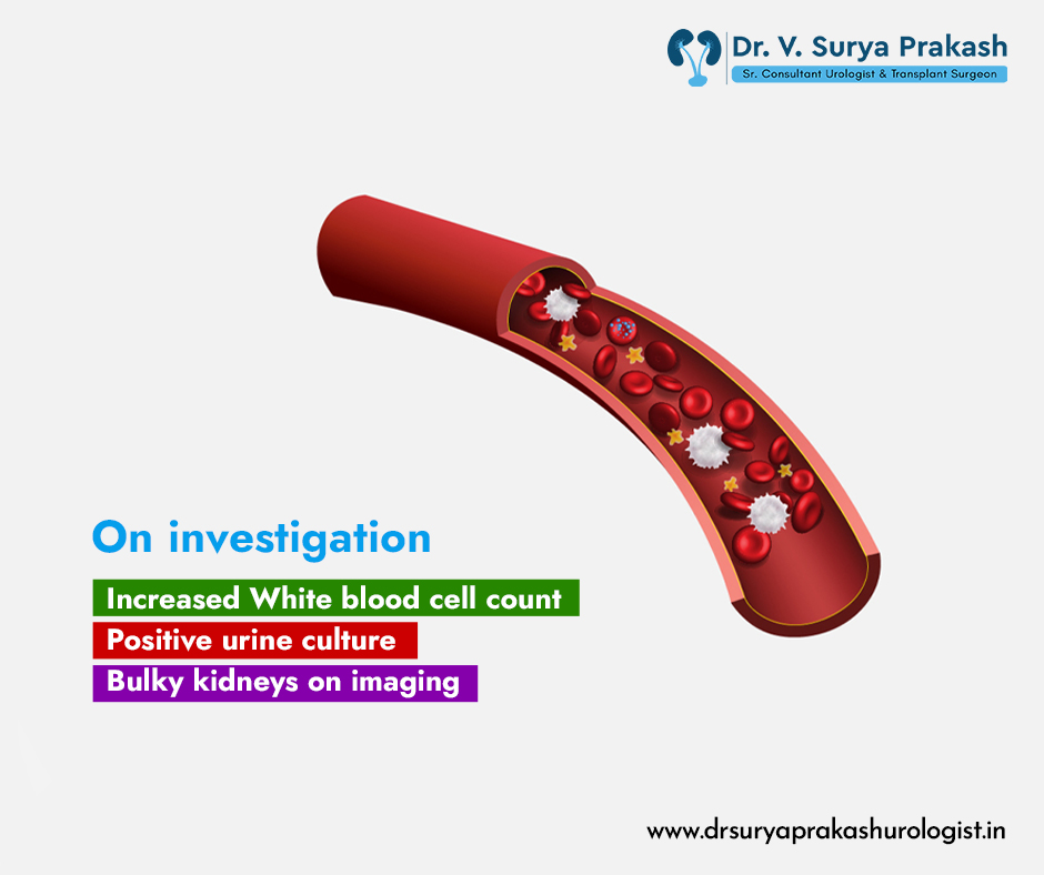 A combination of these symptoms and test results often indicates a urinary tract infection has advanced to a severe stage that could have systemic consequences. 
#drsuryaprakashurologist #yashoda #urologist #warningsigns #urinarytractinfection #urinarytract #uti #fever #flankpain