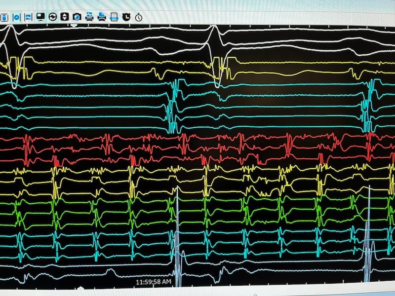 louise (@drlouisesegan) on Twitter photo Young male, highly symptomatic PAF 6 months post PVI. RPVs reisolated but AF persisted. DCR with ectopy-triggered AF arising from SVC. AF term during SVC isolation, SVC remained in Afib #EPeeps #NonPV triggers <a href="/davidchieng/">David Chieng</a> <a href="/peterkistler3/">peterkistler MBBS PhD FHRS</a> <a href="/Vosko1984/">Alex Voskoboinik</a> Young male, highly symptomatic PAF 6 months post PVI. RPVs reisolated but AF persisted. DCR with ectopy-triggered AF arising from SVC. AF term during SVC isolation, SVC remained in Afib #EPeeps #NonPV triggers <a href="/davidchieng/">David Chieng</a> <a href="/peterkistler3/">peterkistler MBBS PhD FHRS</a> <a href="/Vosko1984/">Alex Voskoboinik</a>