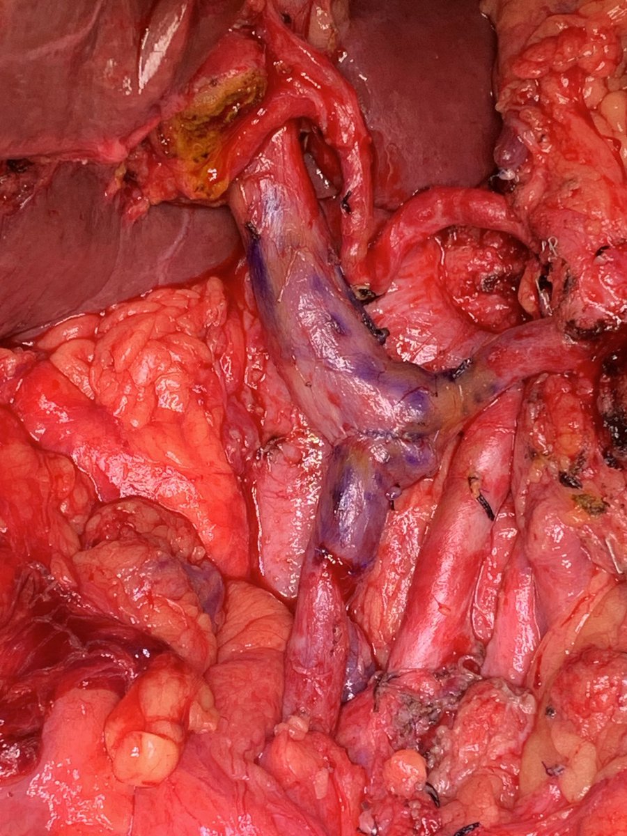Dr Siobhan McKay our international HPB fellow’s handy work of sma divestment and SMV/PV resection with transverse repair for post NAC BR (Art) PDAC.