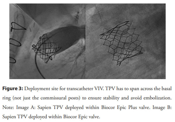 Congratulations!! Dr. @shabanasha3011 & @amrmatoq article 'Transcatheter pulmonary valve-in-valve implantation' is now published in Interventional Cardiology.   
openaccessjournals.com/articles/trans…

#Cardiology #Cardiotwitter #Cardiology #Heartfailure #journal #MedicalScience #TrendingNews