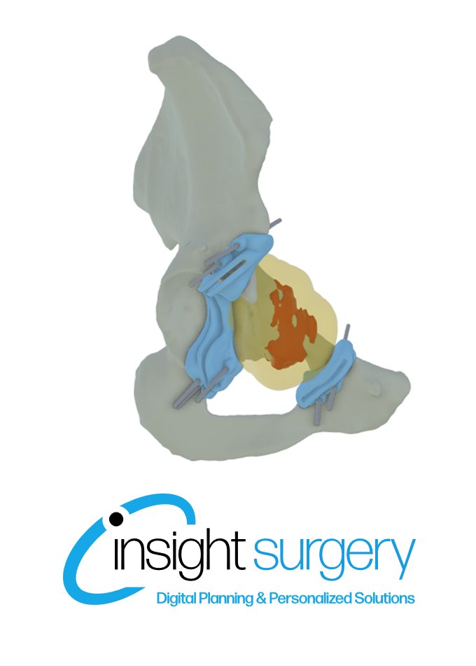 A recent chodrosarcoma case. Our guides ensured resection margins of 10mm, to conserve the patient's acetabulum

Proud to collaborate with <a href="/OUHospitals/">OUH</a>, with our guides expertly manufactured at the renowned Nuffield Orthopaedic Center

#personalized #orthopedicsurgery