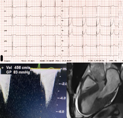 Rafael González Manzanares (@rafaelglezm) on Twitter photo First treatment with Mavacamtem in Andalusia was started today at <a href="/Cardio_HURS/">CardioHURS</a> . 49yo male, HOCM (83mmHg gradient), NYHA class III. Previous treatments with BB, CCB, and Disopyramide were unsuccessful. Looking forward to seeing the response! First treatment with Mavacamtem in Andalusia was started today at <a href="/Cardio_HURS/">CardioHURS</a> . 49yo male, HOCM (83mmHg gradient), NYHA class III. Previous treatments with BB, CCB, and Disopyramide were unsuccessful. Looking forward to seeing the response!