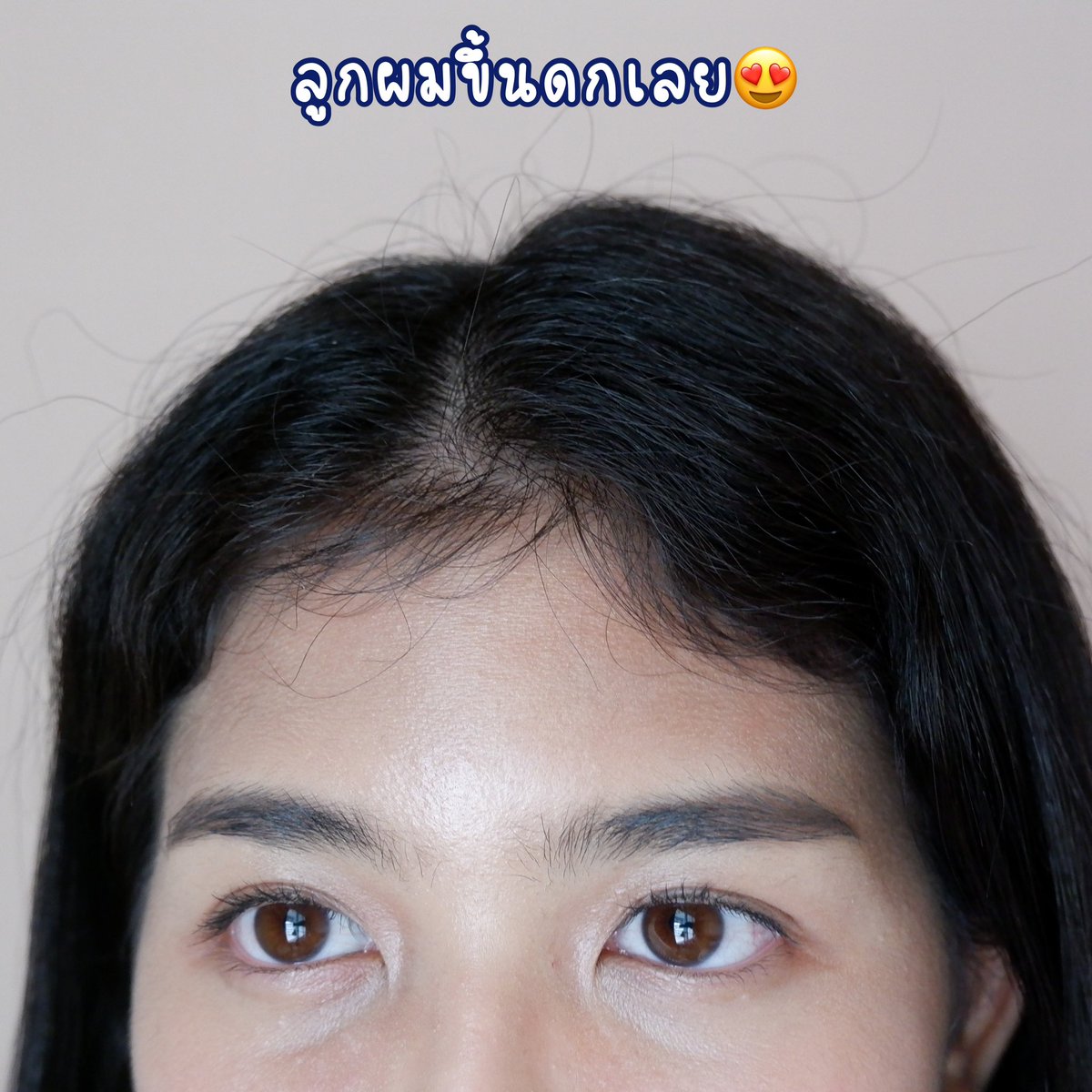 nooktiyaa's tweet photo. ใครมีปัญหาผมร่วงเพราะทำเคมีบ้าง ทางนี้มีตัวช่วยเป็นวิตามินช่วยสร้างโปรตีนให้เส้นผม #HERA แบรนด์ #mortiw #หมอทิว สารสกัดมีทั้งใบแปะก๊วย ไบโอติน หญ้าหางม้า นี่กินมาซักระยะหนึ่งรู้สึกว่าเส้นผมแข็งแรง ลูกผมขึ้นดกเลย ตอนหวีผมร่วงน้อยลงด้วย ประทับใจมาก☺️ #ผมบาง #ผมร่วง #บำรุงหนังศรีษะ https://t.co/Tpf8zIn9nZ