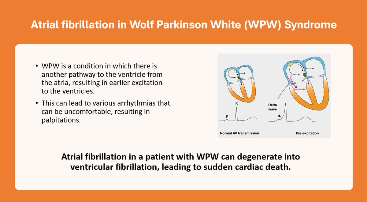 Wolf Parkinson White (WPW) syndrome and Atrial Fibrillation can be a deadly combination. #themoreyouknow #AtrialFibrillationAwareness #Epeeps @PamelaMasonEP @EPeeps_Bot @ACCinTouch