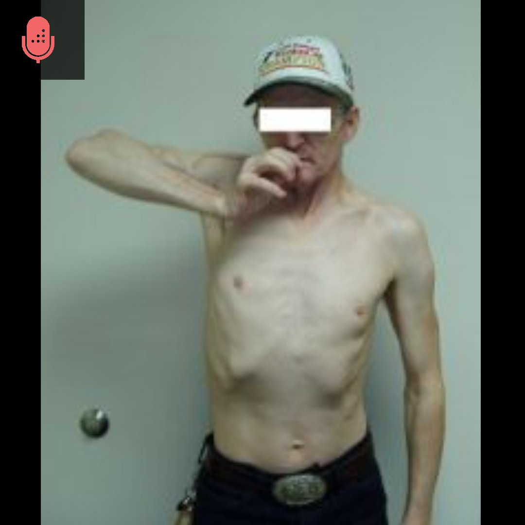 orthobullets's tweet photo. The shoulder exam involves inspection, palpation, range of motion, neurovascular exam, and provocative tests. Inspection is important to evaluate for symmetry, swelling, and hypertrophy. Palpation should include all bony prominences such as the sternoclavicular joint, acromioclavicular joint, and scapular spine. Range of motion should involve six planes, forward elevation of 180°, abduction to 90°, external rotation at 90° of abduction, external rotation at side to 80°, internal rotation to T4-8, and internal rotation at 90° abduction. Neurovascular exam should evaluate nerve roots C4-T1. Provocative tests should evaluate for impingement, rotator cuff pathology, labral injuries, bicep injuries, AC joint pathology, and instability.

Learn more on our DAILY Orthobullets podcast. #orthotwitter
https://t.co/RH9TmNnME7