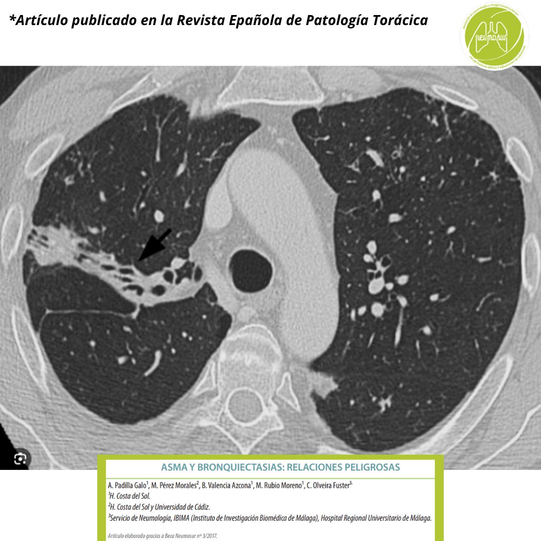 𝐀𝐒𝐌𝐀 𝐘 𝐁𝐑𝐎𝐍𝐐𝐔𝐈𝐄𝐂𝐓𝐀𝐒𝐈𝐀𝐒. 𝐑𝐄𝐋𝐀𝐂𝐈𝐎𝐍𝐄𝐒 𝐏𝐄𝐋𝐈𝐆𝐑𝐎𝐒𝐀𝐒.
Os dejamos el enlace a este interesante artículo publicado en nuestra revista:
rev-esp-patol-torac.com/files/publicac…

#revistaespañoladepatologíatorácica #neumosur