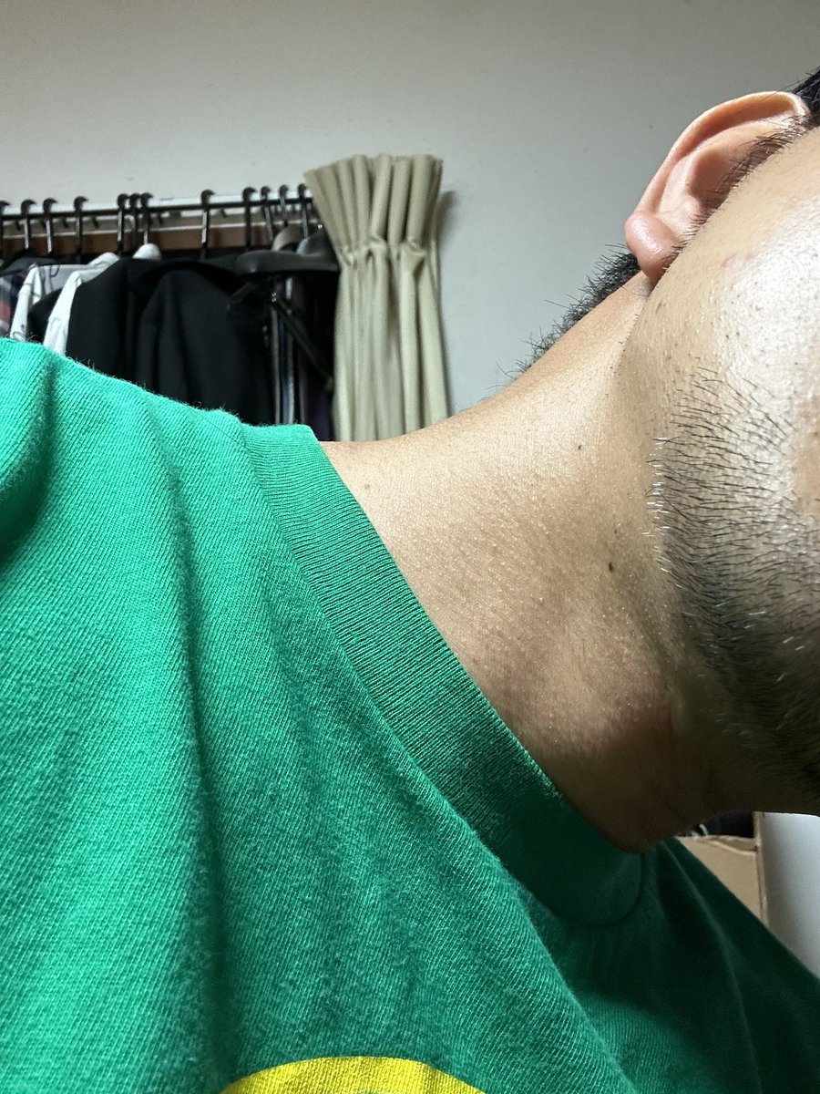 切開リフト後久しぶりに髭の一部を剃りました

すると
そこから生えてきたのは全て白髪😱😱😱

そんなことあるんですか！？！？

もう髭が怖くて剃れません
#rex 
#切開リフト 
#バッカルファット 
#メーラーファット
#整形垢 
#韓国 
#整形
#ANA
#voco
#ダウンタイム
#メンズ美容
#白髪