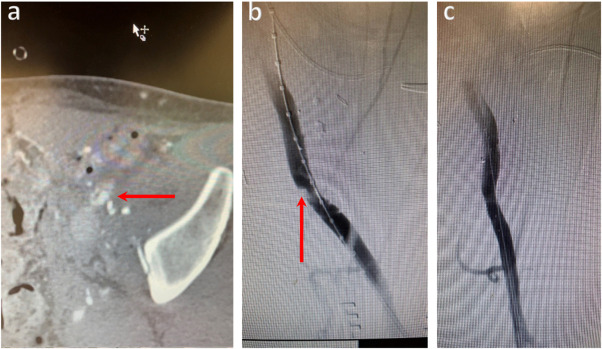 Recent advances and the future of abdominopelvic and lower extremity vascular injury management

Excellent review of #Vascsurg #trauma by @mahmoodkabeil @doctormaxw - check it out!
@MarioDOria14 @CaitlinWHicks  

sciencedirect.com/science/articl…