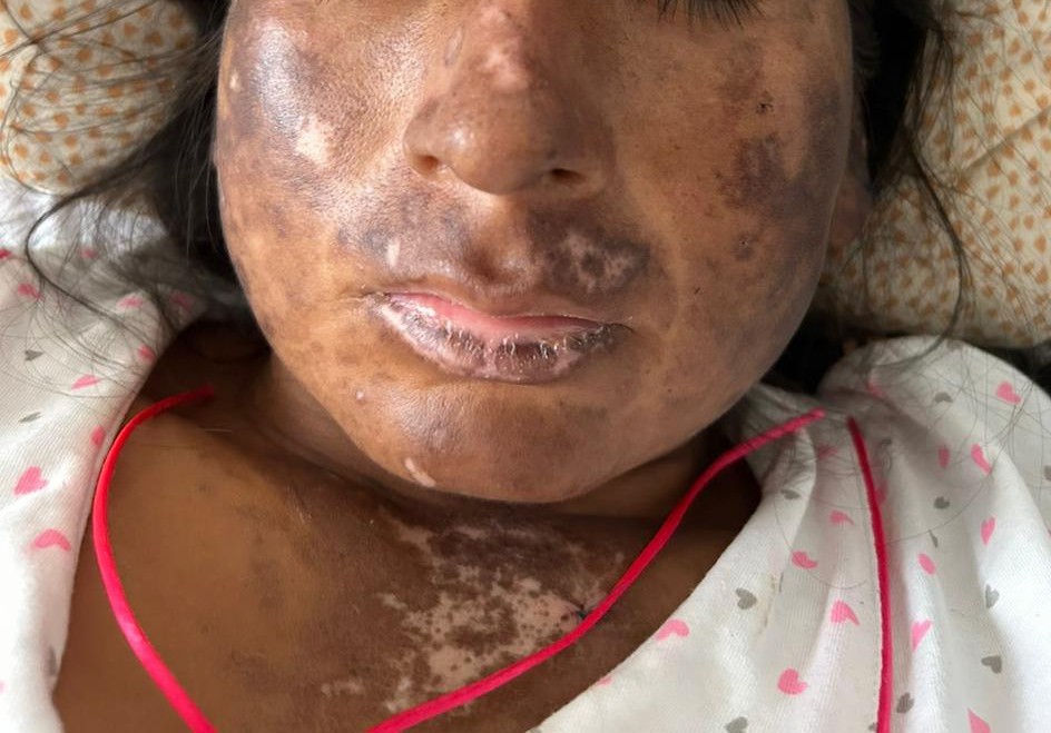 ConsejosReumato's tweet photo. Mujer de 27 años con #lupus, desde el inicio del embarazo presentó cambios dérmicos, #artritis y #alopecia . Un mes antes del parto desarrolló #orina espumosa. La foto (#puerperio) muestra cambios de #poikiloderma (hiper e hipopigmentación , atrofia y #telangiectasias). #sle https://t.co/9hX4QyT1UK