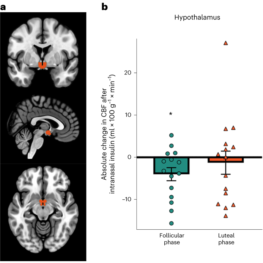 Exciting insights from our research: Brain insulin action boosts peripheral insulin sensitivity in women, but intriguingly, only during the follicular phase of the menstrual cycle.
<a href="/Steph_Kullmann/">stephanie Kullmann</a> <a href="/DiabResearch/">Deutsches Zentrum für Diabetesforschung (DZD)</a> <a href="/uni_ulm/">Universität Ulm</a>
go.nature.com/3ZtwbeL