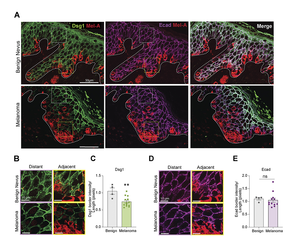 .<a href="/HopeEBurks/">Hope Burks</a> &amp; colleagues in <a href="/KathyGreenLab/">The Green Lab</a> show how #melanoma cells hijack keratinocyte paracrine signaling for their own benefit through repression of the desmosomal cadherin desmoglein 1, associated w/ increased melanoma cell spread. bit.ly/3LBdQXd
#Cancer #desmosomes