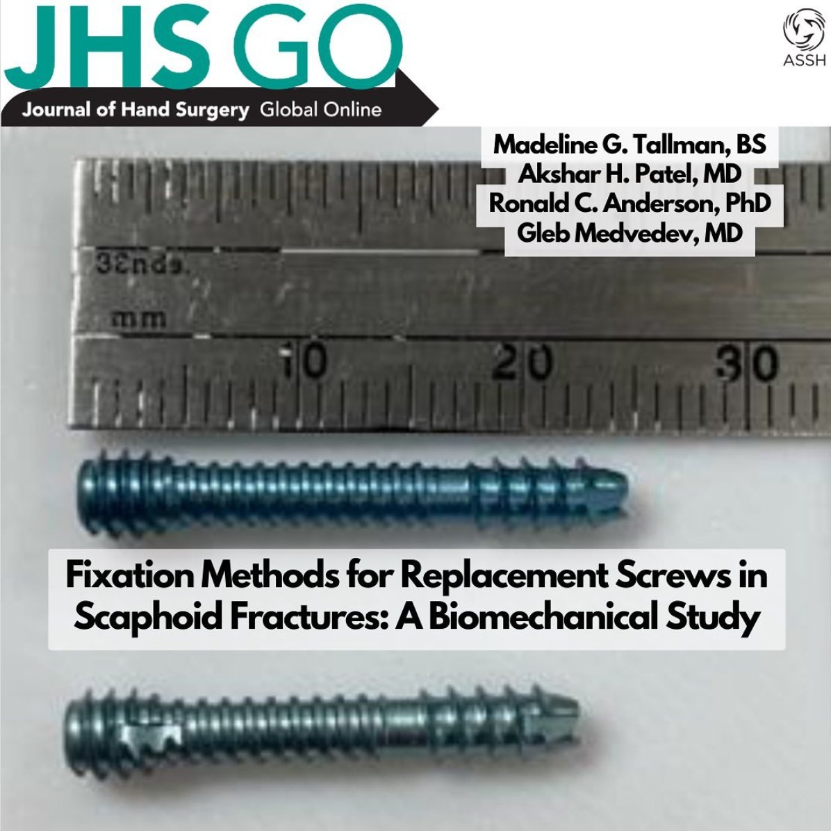 Tulane Orthopaedics (@tulaneortho) on Twitter photo Authors from <a href="/TulaneOrtho/">Tulane Orthopaedics</a> & <a href="/TulaneBME/">Tulane Department of Biomedical Engineering</a> investigate the changes in biomechanical fixation of an initial and replacement headless compression screw by quantifying interfragmentary compression and shear displacement. Read the findings in <a href="/JHSGlobalOnline/">JHS GO</a> -> bit.ly/3RMvgnV. Authors from <a href="/TulaneOrtho/">Tulane Orthopaedics</a> & <a href="/TulaneBME/">Tulane Department of Biomedical Engineering</a> investigate the changes in biomechanical fixation of an initial and replacement headless compression screw by quantifying interfragmentary compression and shear displacement. Read the findings in <a href="/JHSGlobalOnline/">JHS GO</a> -> bit.ly/3RMvgnV.