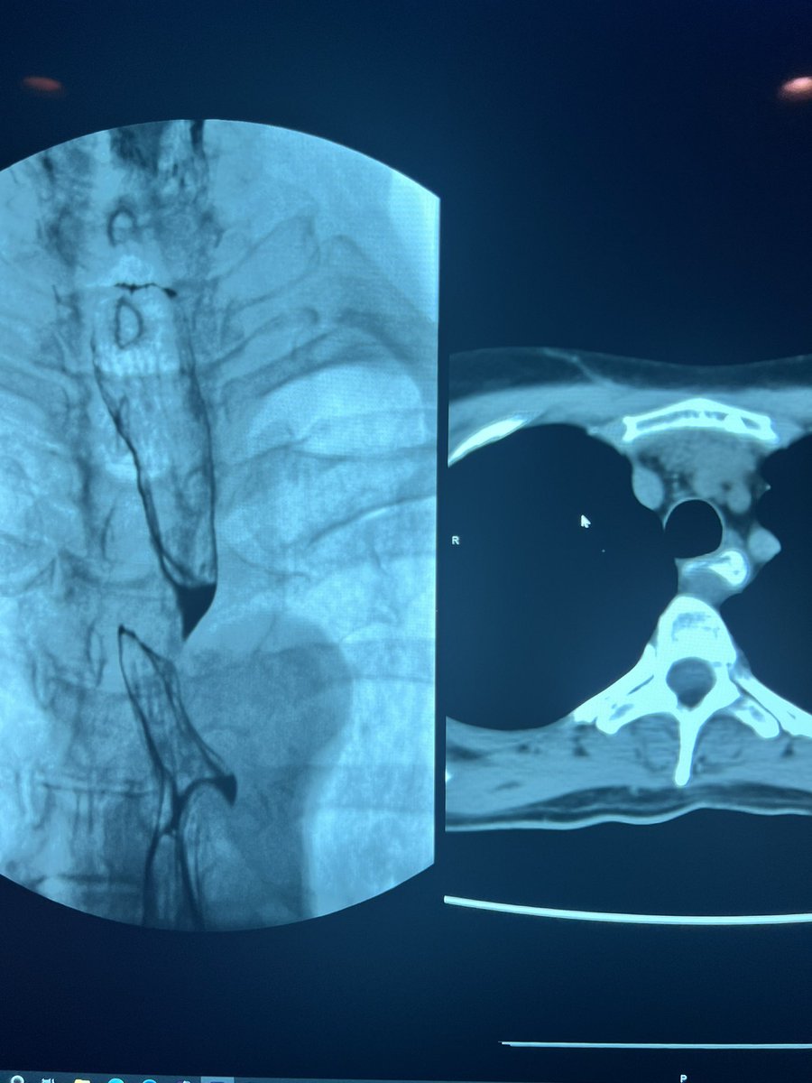 This patient apparently read the text book. 20 years of dysphasia, multiple endoscopies, no answers.

3rd time I’ve diagnosed this pathology in the past 2 months, prevalence of 1.8% in the general population. 

Diagnosis? 
#raded #raded #radiology