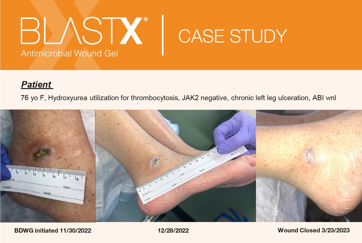 🔬 Exciting Case Study 📊: We applied BLASTX to a stubborn chronic leg ulcer as part of a 3-patient pilot study. After 16 weeks, the wound was fully closed! Learn more: nextscience.com/wp-content/upl…
#ChronicWound #BLASTX #WoundCare 🩹