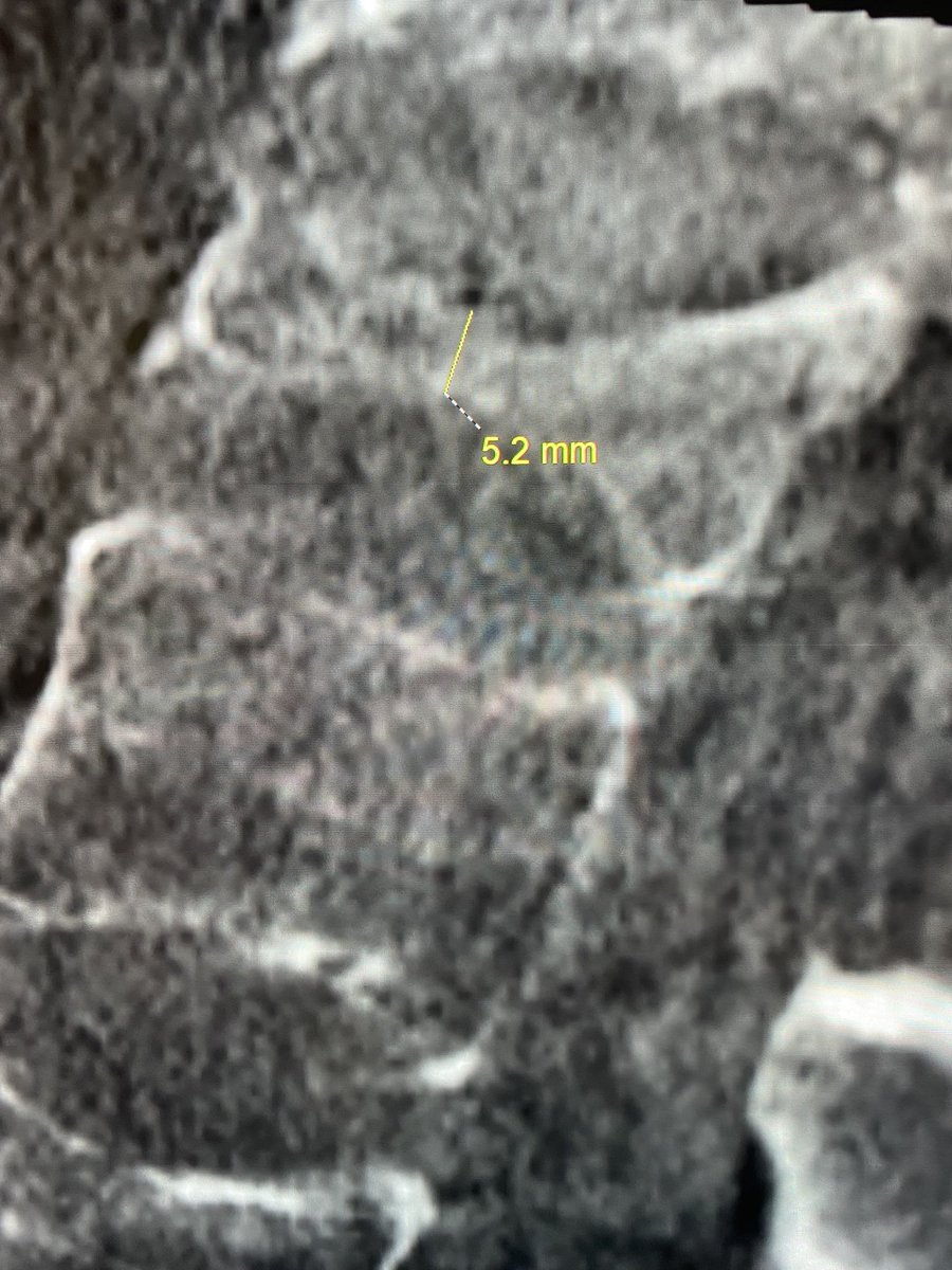 Boise Neurointervention tweet media