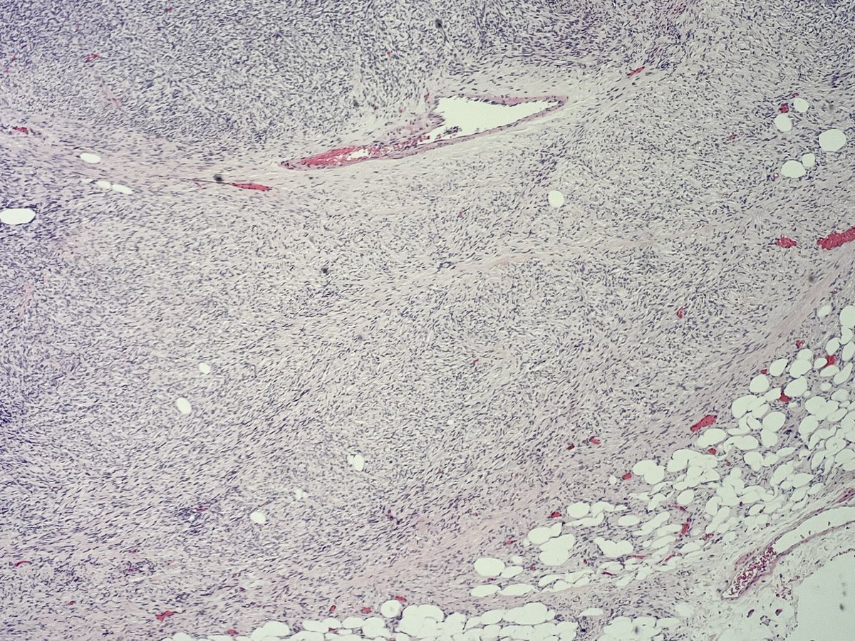 JDCo2pock's tweet photo. 85-year-old with 5 cm subcutaneous thigh mass with ulceration. Fascicular/herringbone spindle cell neoplasm with peripheral storiform areas with adipocyte entrapment which express CD34, lost in fascicular component. DFSP with fibrosarcomatous transformation. https://t.co/6akAscmXbW
