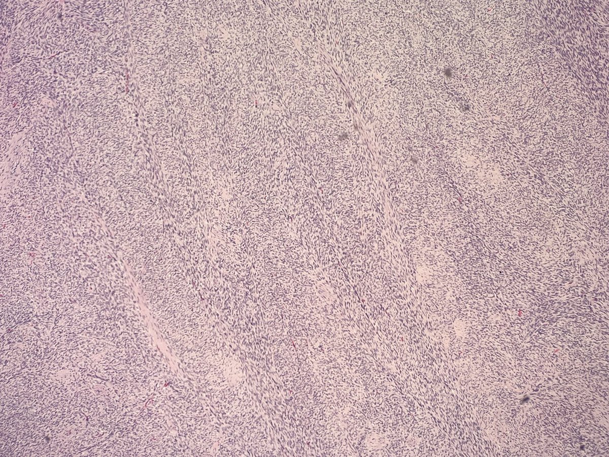 JDCo2pock's tweet photo. 85-year-old with 5 cm subcutaneous thigh mass with ulceration. Fascicular/herringbone spindle cell neoplasm with peripheral storiform areas with adipocyte entrapment which express CD34, lost in fascicular component. DFSP with fibrosarcomatous transformation. https://t.co/6akAscmXbW