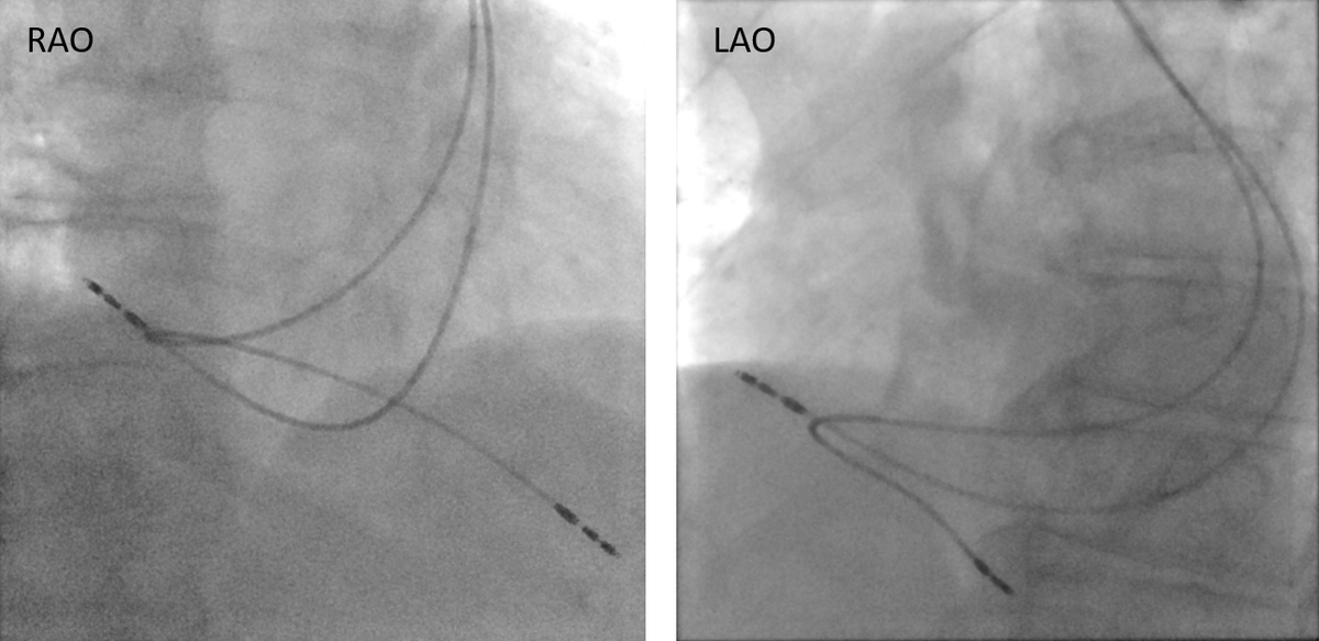 Circuitous path for left-sided dual chamber pacemaker implantation in a patient with persistent LSVC and no bridging vein
