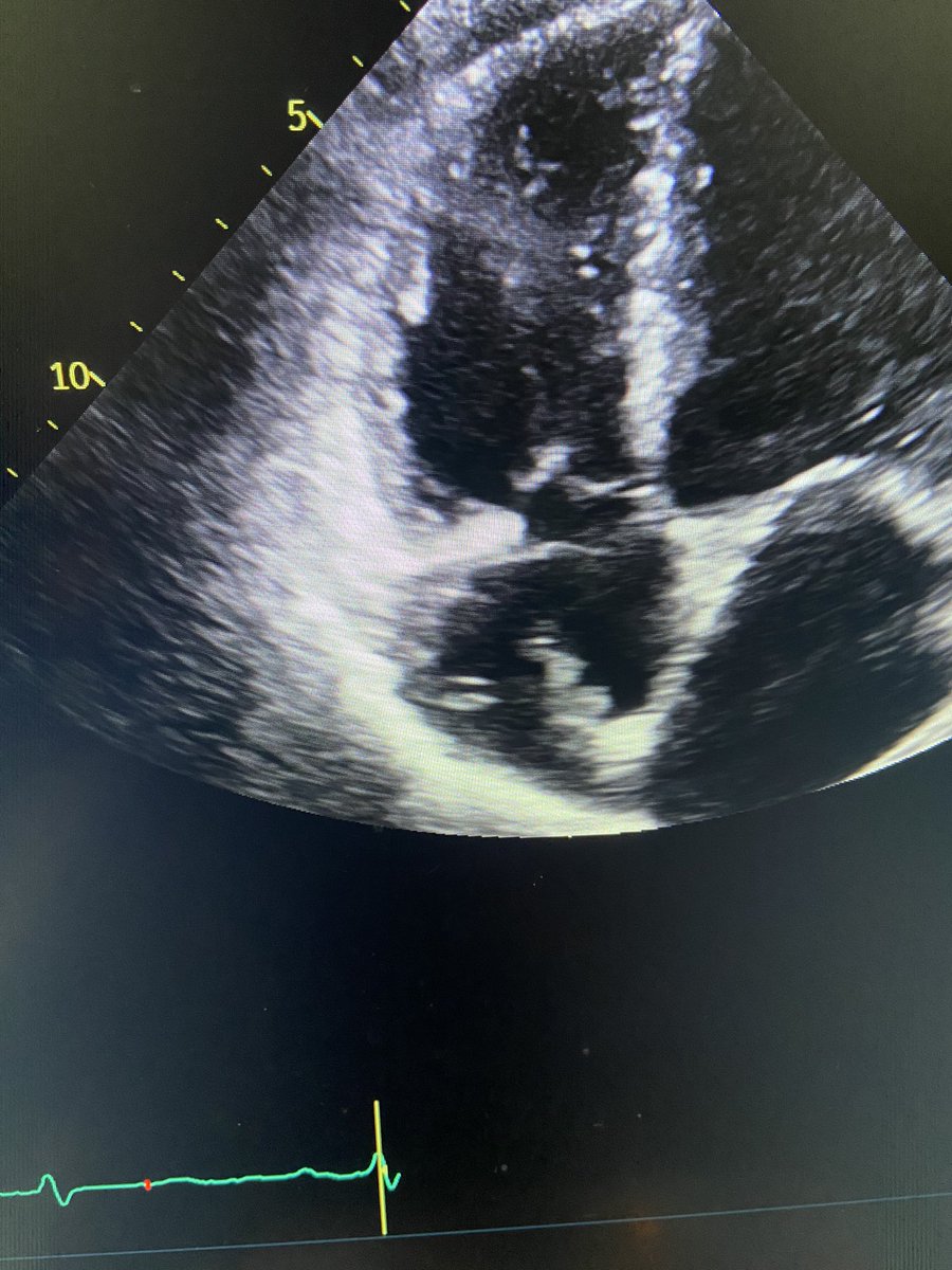 CarrilloDocMex's tweet photo. 👩🏻‍🦰 31@. CKD haemodialysis AV fístula. 
Dyspnea. Tricuspid hypoplasia #echofirst #cardiology https://t.co/2nLPGlv8mb
