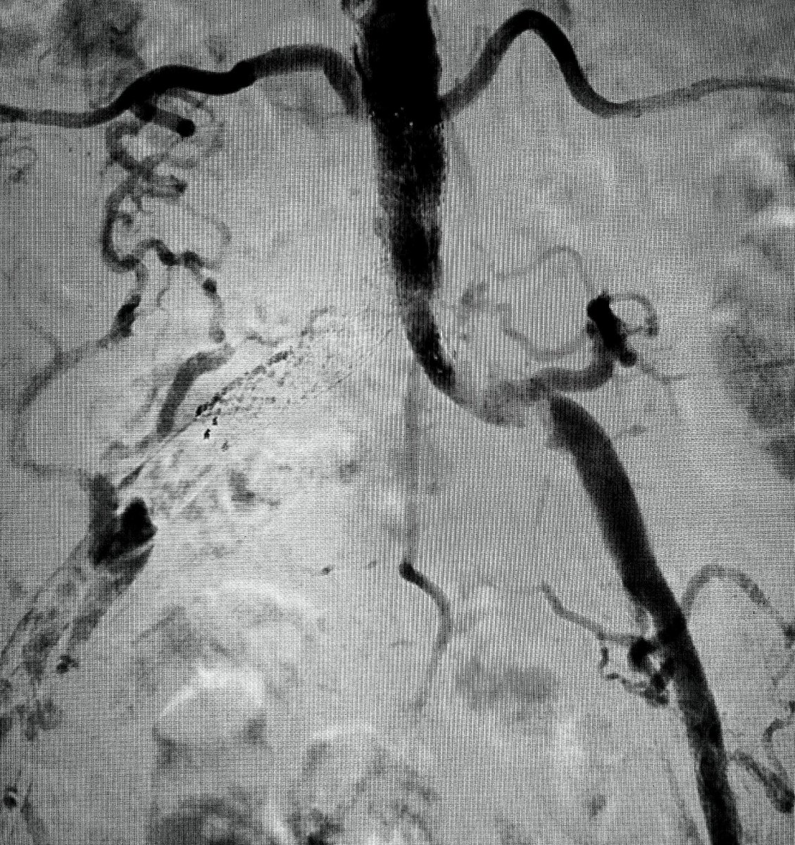 Severe claudicant with early failure of double barrel iliac stents extending far into aorta within 1.5 years. 

Options? 

#AortaEd #CLIfighters