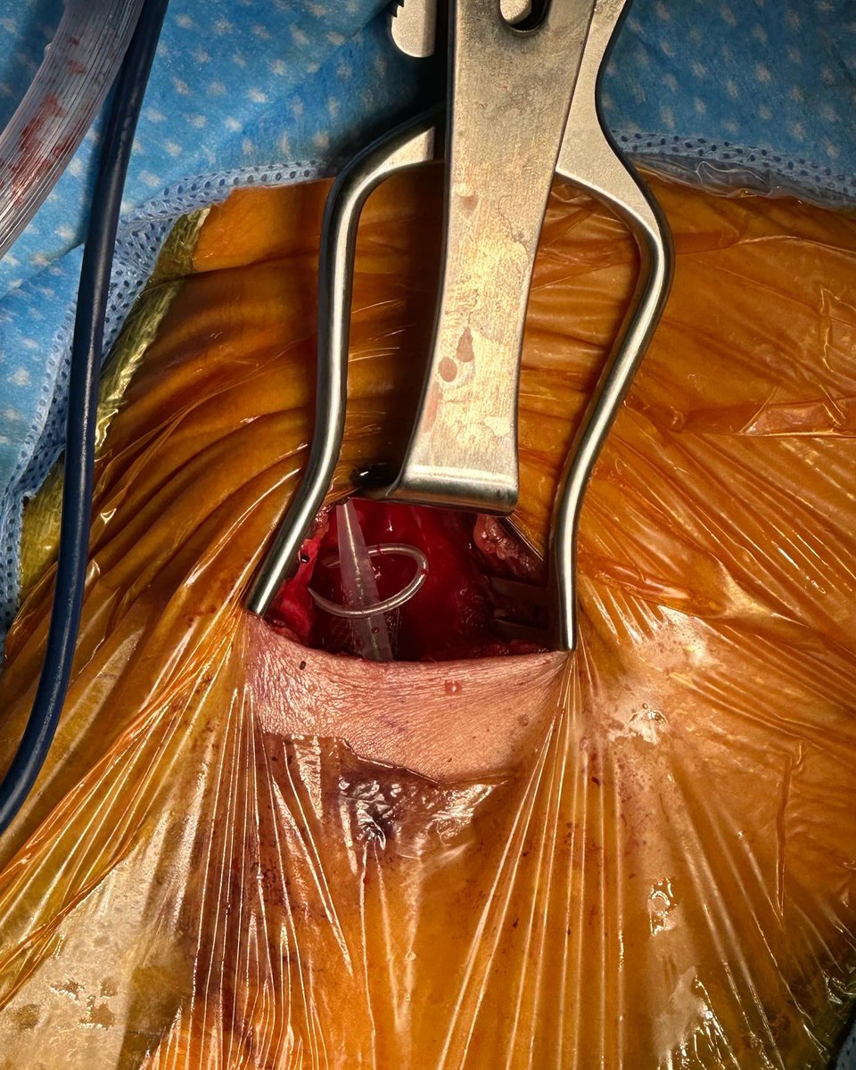 Kudos to Dr. Stoner and Vascular Surgery Team for performing the first BAROSTIM implantation in the URMC!
This novel technology brings minimally invasive heart failure treatment to the Rochester region