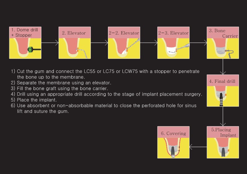 csmimplant's tweet photo. Sinus Lift Kit ( Lateral) Dome type
#surgicalkits #dentalimplants #implantskorea #csmimplant #manufacturing #manufacturerkorea https://t.co/nE1hK0Oeck