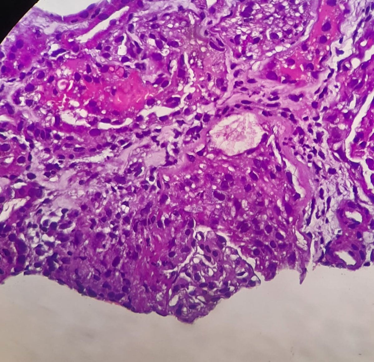 archibhat3's tweet photo. In late 50s, presented with rapid worsening of renal function, proteinuria, hematuria. No H/O diabetes or hypertension. Light microscopy images of the renal biopsy here #KAPCONPathX2023 #KAPCON2023 @VijayPatho @adi_agnihotri @AskRenalPath @arkanalabs #PathTwitter #pathspotter https://t.co/tT7U9NFeEe