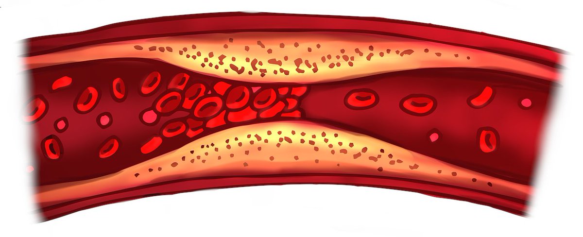 Do you know your cholesterol numbers? 🧐

LDL: < 70 mg/dL if you have heart disease.
LDL: 100-130 mg/dL if no heart disease is ok. 
HDL: Keep it above 40 mg/dL. 
Triglycerides: Aim for under 150 mg/dL.

Talk to your doctor for personalized goals.  #CholesterolLevels #HeartHealth