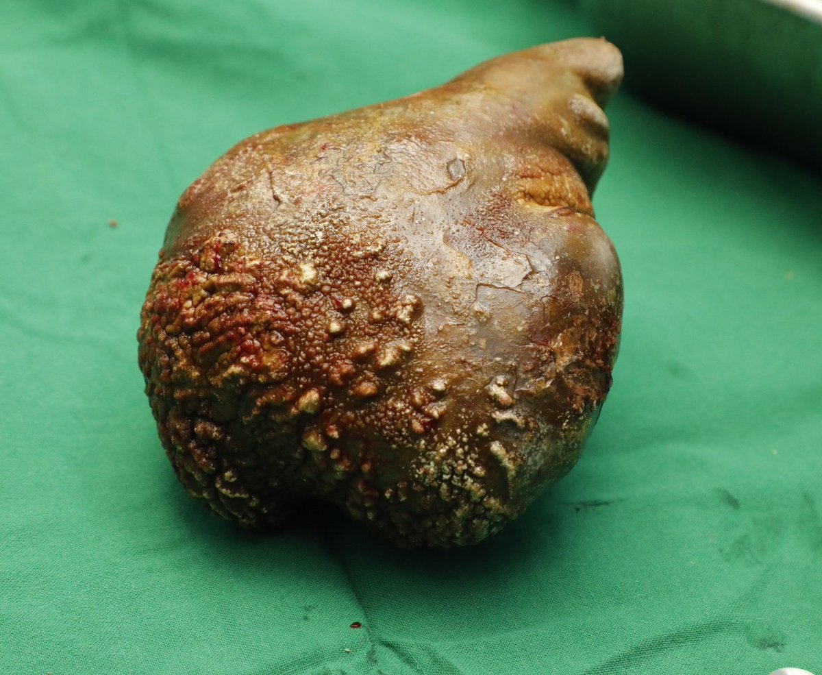 FirstDoctor's tweet photo. Surgeons in Sri Lanka removed this massive kidney stone, the largest and heaviest on record ever removed from a human.

The stone was 13.37 cm long, 10.55 cm wide, and weighed 800 grams, the weight of five baseballs or nearly two FIFA footballs. The patient recovered well.

6 things that can increase your risk of having kidney stones:

1. Dehydration: so make sure you drink enough water always.

2. Being too fat: you see that belly fat, it's the worse.

3. Having weight loss surgery: e.g. gastric bypass surgery.

4. Doing rigorous exercise under very dry weather conditions: if weather is very dry, drink loads of fluids before, during and after you exercise.

5. Other medical conditions: e.g. repeated urinary tract infections (UTI); treat your UTI promptly and adequately.

6. Eating too much salt or sugar: watch what you eat.

Repost: for others