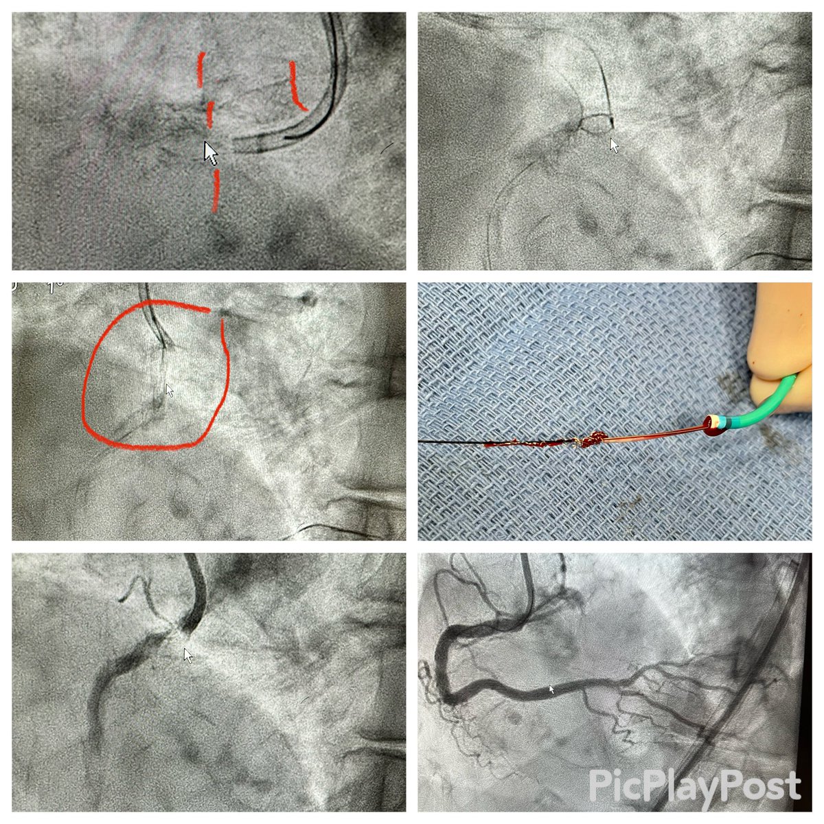 Referral for “stent-ectomy”:: gooseneck snare 🎣 removal of prior stent, calcium 🪨 modification with IVL⚡️, re-stent with IVUS 👁️ guidance 👍…