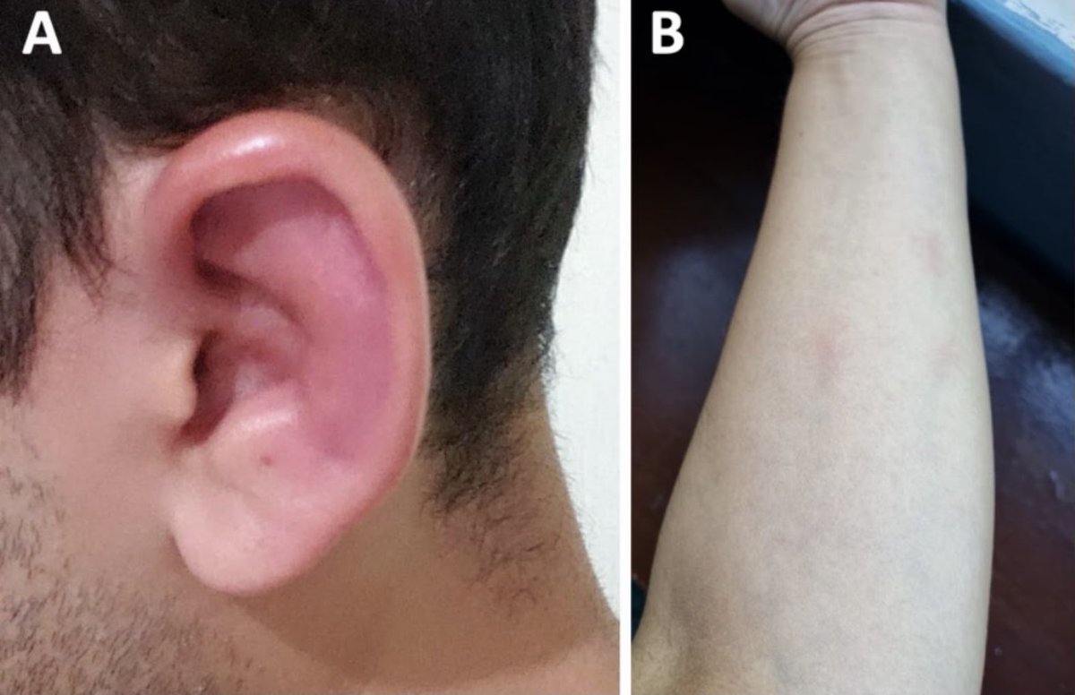 Eduardo Martín-Nares (@drlalonares) on Twitter photo 👆🏼#VEXAS syndrome is believed to only affect individuals above the age of 50.
😮We describe an early-onset case in a 23 y/o 🙎🏽♂️ with relapsing polychondritis.
🗝️Test for UBA1 mutations🧬, regardless of age, in adults with a VEXAS clinical phenotype.
<a href="/ivette_pataki/">Dra. Pataki</a> <a href="/RheumJnl/">Rheumatology & Rheumatology Advances in Practice</a> 👆🏼#VEXAS syndrome is believed to only affect individuals above the age of 50.
😮We describe an early-onset case in a 23 y/o 🙎🏽♂️ with relapsing polychondritis.
🗝️Test for UBA1 mutations🧬, regardless of age, in adults with a VEXAS clinical phenotype.
<a href="/ivette_pataki/">Dra. Pataki</a> <a href="/RheumJnl/">Rheumatology & Rheumatology Advances in Practice</a>