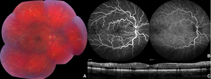 Mayo Clinic Department of Ophthalmology (@mayocliniceye) on Twitter photo <a href="/LADalvinMD/">Lauren A. Dalvin, MD</a> & <a href="/MRStarrMD/">Matt Starr, MD</a> share this photo essay in @CanJOphth. Diagnosis: Hyperviscosity retinopathy from chronic myelogenous leukemia. bit.ly/3ERR4GV <a href="/LADalvinMD/">Lauren A. Dalvin, MD</a> & <a href="/MRStarrMD/">Matt Starr, MD</a> share this photo essay in @CanJOphth. Diagnosis: Hyperviscosity retinopathy from chronic myelogenous leukemia. bit.ly/3ERR4GV