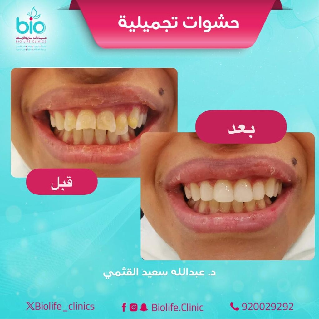 biolife_clinics's tweet photo. 🔖حالة حشوات تجميلية
👩‍⚕️د. عبدالله سعيد القثمي 
👈استشاري تجميل وإصلاح وزراعة الاسنان 

📲احجز/ي موعدك الآن
☎️ 920029292 - 0126620208
📞 0552304433- 0539394004
.
.

#اسنان #تجميل #زراعة_الأسنان #تركيبات_اسنان #اصلاح_اسنان #جدة #السعودية #جدة_لايف https://t.co/LorYXJOUpB