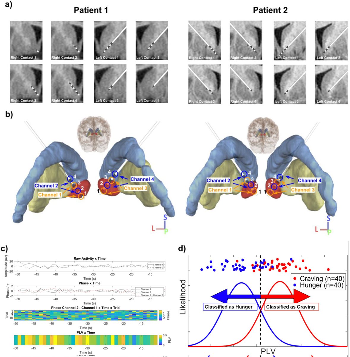 Super proud of the team and our work demonstrating how real world network connectivity can be used to inform  behavior. Cammie, <a href="/GraceNg_MD/">Grace Ng, MD MSc</a>, Young-hoon, Rajat, Josh, <a href="/DaniSBassett/">Dani S. Bassett</a>, <a href="/halpernc/">Casey H. Halpern</a> <a href="/StanfordNsurg/">Stanford Neurosurgery</a> <a href="/PennNSG/">Penn Neurosurgery</a> sciencedirect.com/science/articl…