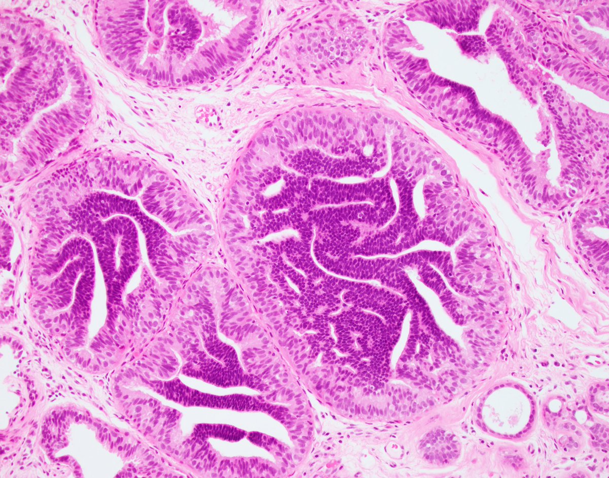fouad_boulos's tweet photo. Thank you all for your comments. As I expected, the responses were mixed, but ADH was a clear winner in the first case, in part driven by the need and recommendations to be more conservative in our core biopsy diagnoses, and in part because of the presence of two cell populations, the background columnar cell hyperplasia and the overlying (what I like to call) bridging micropapillary atypical proliferation. DCIS was more popular in the second case, because of the presence of contiguous spaces with complete involvement. The size was right at 2 mm though. To be sure, both cases made me pause and carefully consider ADH and DCIS options at length, but I did eventually opt for ADH. 

Below, I will detail how I have come to consider ADH in a way that brings a little clarity and understanding to my thought process. It is of course based on the general criteria advanced by David Page in his seminal "Cancer" paper from 1985.

1.  Atypical hyperplasia is not really a small DCIS. In his original paper, David Page says that ADH is a lesion that has some but not all the characteristics of DCIS, and because the definition of DCIS he previously put forth stated that the proliferation had to be uniform, completely involve two contiguous spaces, and measure more than 2 mm in diameter, it followed that ADH would be characterized by smaller size, incomplete involvement of spaces, complete involvement of a single space, and a uniform subpopulation of cells.  The problem with this definition is that it could imply that atypical ductal hyperplasia is merely an early form of DCIS which, if given time, would evolve into full-fledged  DCIS.  Although that may be the case in some instances, instances which we cannot in my opinion morphologically discern, it goes against the risk model that was also introduced by David Page which states that the risk of subsequent invasive carcinoma for DCIS is ipsilateral and geographically concordant with the biopsy site, while the risk of subsequent invasive carcinoma following ADH is bilateral and comparable in both breasts. if these two lesions were one and the same but at different stages of development, then the contralateral breast cancer risk should be identical. The fact that it isn't suggests a fundamental difference between  ADH and DCIS.  I view this fundamental difference's morphological  manifestation as follows:  While DCIS arises from a single clone that starts in a lobular unit, completely involving it and spreading to adjacent lobular units through intervening ducts (hence the complete involvement of two adjacent spaces over a span of >2 mm), ADH is more akin to mushrooms arising over a widespread mycelium, the mycelium generally representing different varieties of columnar cell change. In other words, while usual ductal hyperplasia is a polyclonal proliferation of cells with a variety of phenotypes, and while DCIS is a single neoplastic clone, ADH is multiple small separate clones on a backdrop of columnar cell change. The one exception that most readily blurs the line between ADH and DCIS would then be micropapillary ADH versus micropapillary DCIS, as micropapillary DCIS can still have columnar cell change in the background and still be extensive with a strong propensity for invasive disease.

2.   Aside from this fundamental difference between ADH and DCIS, disease volume plays an important role in the likelihood of clonal proliferations progressing to invasive cancer.  Let me take this opportunity to make a disclaimer that is both controversial and potentially aggravating to some. All clonal proliferations in the breast are non-obligate precursors for invasive breast carcinoma. I say this with extreme conviction even in the face of an onslaught of criticism and denial. It is but a game of probabilities. The most basic and innocuous of atypical lesions, namely flat epithelial atypia, will occasionally give rise to tubular carcinoma.  ADH not meeting criteria for DCIS will occasionally give rise to low-grade invasive carcinoma. These are rare events because the likelihood of an invasive outcome is proportional to the volume of precursor disease and its mutational burden. In that vein, the reason I was considering low-grade DCIS for the case pictured below is because of the sheer volume of atypia present in the many involved spaces. Computing the risk based on cellular features and volume of disease is of course impossible with our current knowledge and techniques, but knowing that we live in an age of de-escalation of therapy, and that limited examples of DCIS that are excised to widely negative margins are unlikely to cause any future harm to the patient, adopting a conservative stance with borderline lesions such as this one is probably the way to go.

3.   Finally, and to conclude this relatively brief 
and simplified discussion of a highly complex topic, I suggest being conservative with the diagnosis of DCIS when intermediate to high-grade cells are present in a small area, despite the guideline that high-grade DCIS does not need to fulfill size criteria for diagnosis. If high-grade cells are present in small numbers and not completely filling spaces, I use the somewhat vague and non-committal designation "atypical intraductal proliferation" to prompt excision without subjecting the patient to a permanent diagnosis of DCIS before proving a substantial extent of disease and true potential benefit from adjuvant therapy.

Voila. Hope you all have an Xcellent weekend!

@wusm_pathology @washupathedu #breastpath #PathTwitter #PathX #pathology