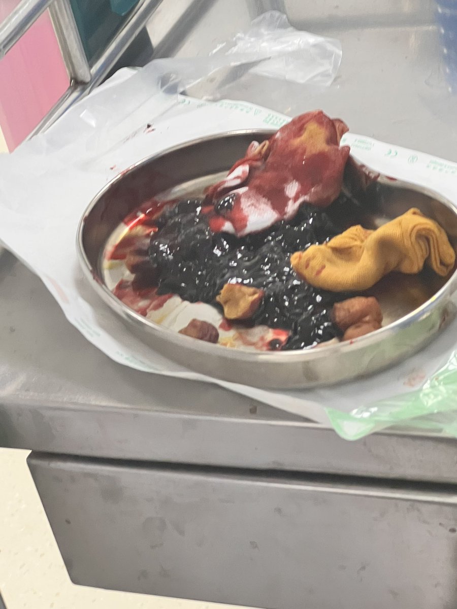 之前的大出血好可怕😟之前在三甲医院处理出来的部分血块，现在想想 当天留了差不多1000cc的血，好危险‼️去医院打完凝血之后，手脚都是麻木的