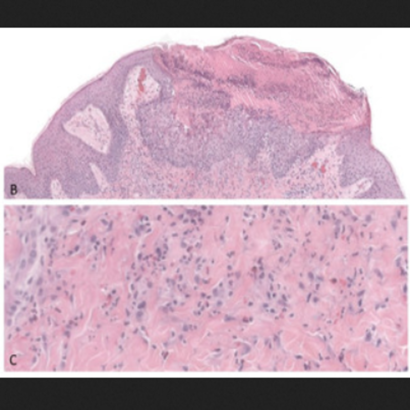 MDPIOpenAccess's tweet photo. See below a collection of significant editor's choice articles by Dermatopathology (ISSN 2296-3529) 👇

#follicularocclusion #eczema #spongiosis
