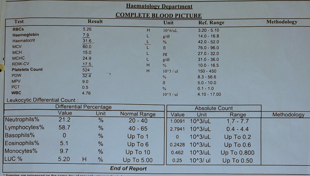 NutritionistKD's tweet photo. #NutritionWeekendPoll 
#CaseStudy

On 12 th Sept, I received a 4yr F 10pm
Weight 5.0kg
Muac 10.8cm
Height ND

Pc Failure to thrive 1/12
     Difficult in breathing 3/7
     Convulsions for 2/7

HxPC
Known 4 years Cerebral palsy patient, was well until 3 months a go, when the child started failing to eat, losing appetite, loss of weight ,Difficulty in breathing associated with grunting sounds.

The mother, too, reports diarrhoea 3-4 times a day and at least for 7 days without responding to treatment got from the clinic.

3 days prior to admission, the mother reports seizures at least 2 episodes lasting for 5 minutes each.

However, the child has had no vomiting.
 
Nutrition history 
Baby was only expressed exclusively breast fed for 2 months, then later the baby was initiated to infant formulars up to 6 months, and complementary feeding was done.

Respiratory system 
There is laboured breathing with chest indrawing. RR 69cm, SPO2 98 % on room air,. Equal air entry noted and crepitations heard.

CVS Warm peripherals 
HS 1 and 11 heard, pulse 135bm.

PA Normal Abdominal fullness
No palpable masses and no organomegalies.

R/S Non remarkable. 

Below are some of the biomarkers done.
Clinical Chemistry,  Vitamin D ,Complete Blood Count.

What are your #DDXs? 
Suggest possible treatment to this baby.

#FridayQuestionPoll.