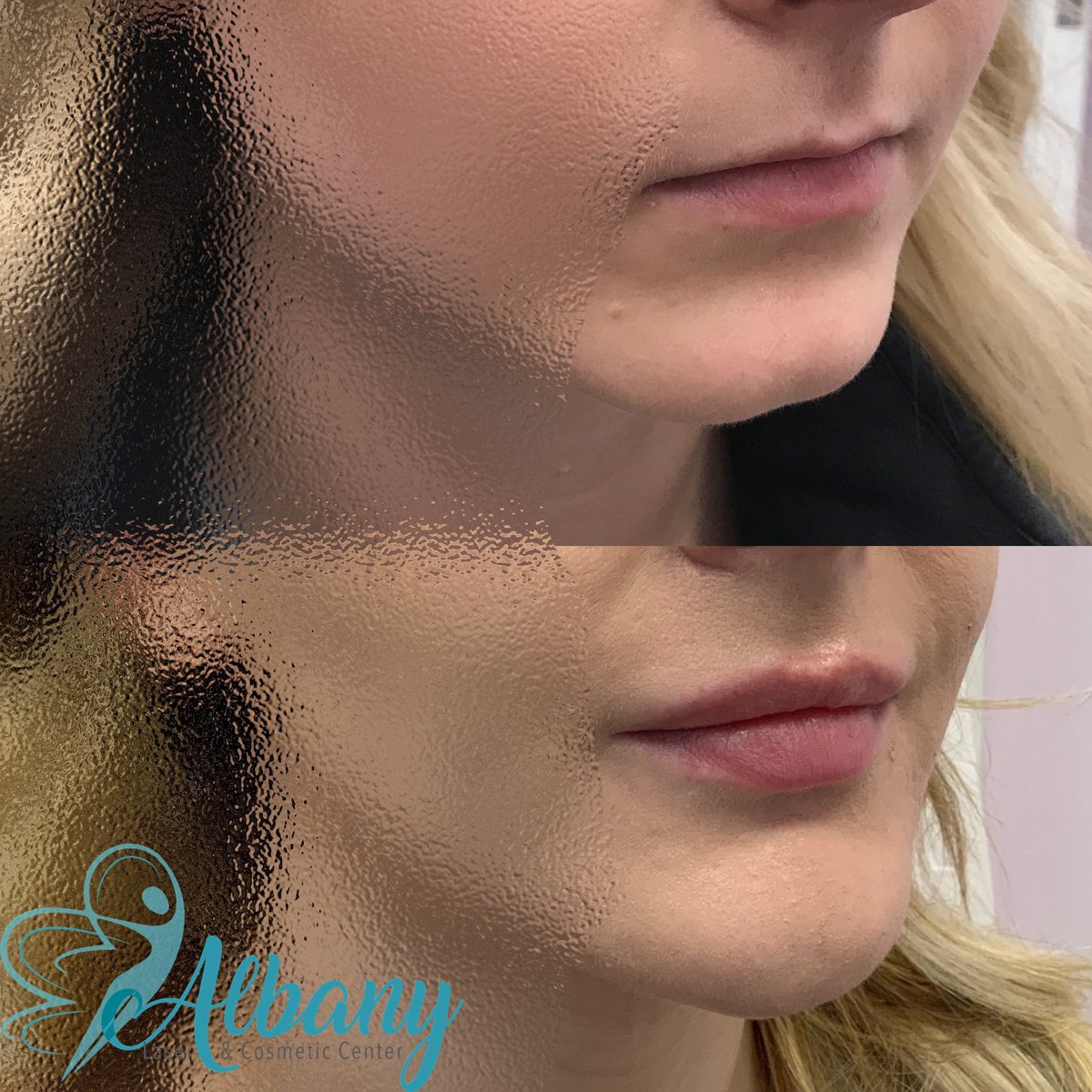 #dermalfillers are perfect solution for #lipaugmentation #chinaugmentation #lipfillers #
albanylaser.ca/services/lip-f…