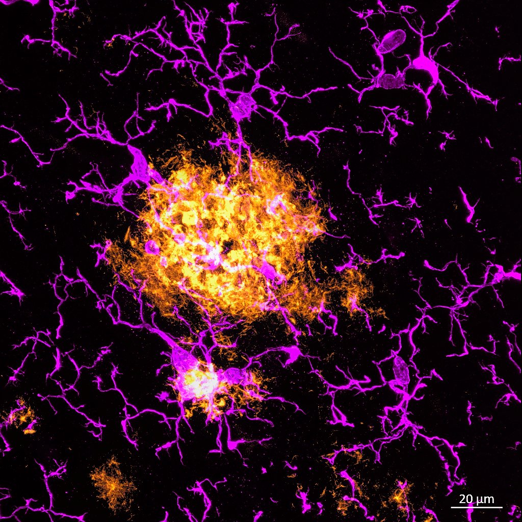 Happy #FluorescenceFriday! Have you seen a Gorilla brain before? This week, I looked at them for the first time 😁🔬! This image is from a 40-year-old female who died of natural causes in a reserve. They also have amyloid plaque (🟡) and check the size of these microglia (🟣)!