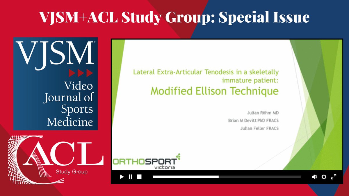 videojsportsmed's tweet photo. Now online! Lateral extra-articular tenodesis in skeletally immature patients: the modified Ellison technique. #ACLStudyGroupVJSM
Watch this @ACLStudyGroup special issue video, here: https://t.co/h7xLHqB1xU https://t.co/BXpKUAUnhD