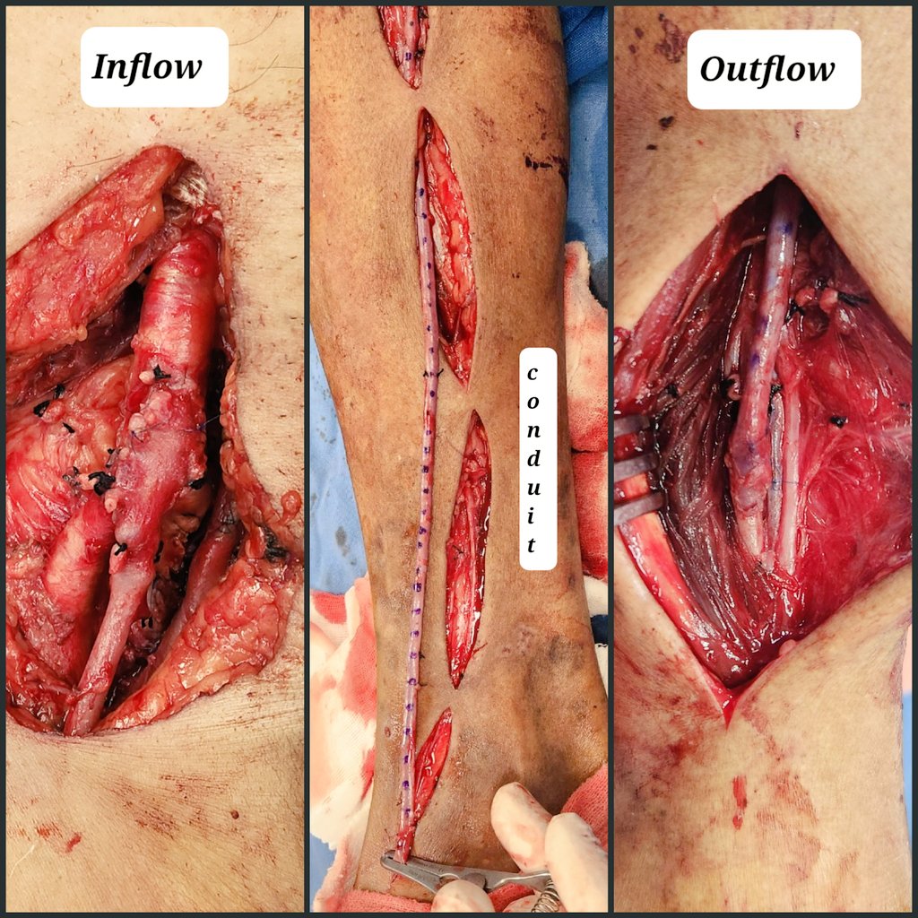 A distal bypass in 3 images:

🩸Inflow
🚆Conduit
🏞Outflow

#CLTIFighters