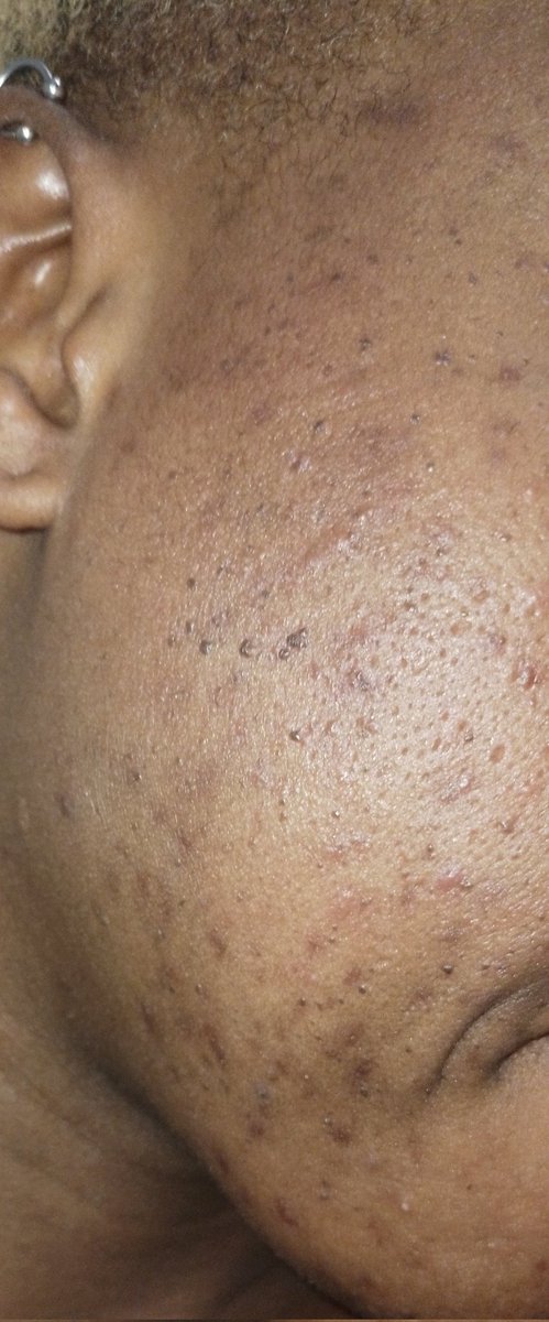 Limsdee's tweet photo. @Tejumola__ I went from this to that in 4 weeks, it was one hell of a roller coaster.

Thank you so much @tejumola for all the amazing Skincare threads. https://t.co/Ys4hRz9d9e