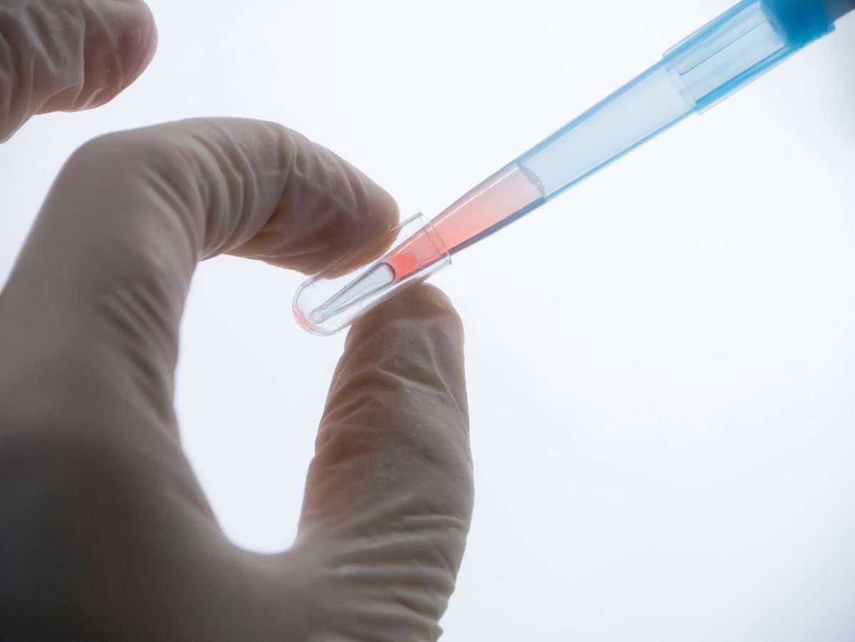 El #Conicet desarrolla un test de detección precoz del #Cancer de mama y de próstata. El test OncoLiq utiliza una tecnología que apunta a detectar en sangre la presencia de moléculas de 'microARNs' liberadas por esos tumores apenas comienzan a producirse.
periferia.com.ar/innovacion/el-…