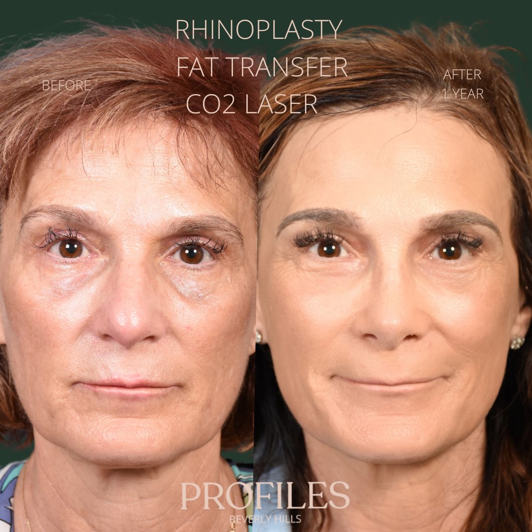 FacialPlastics's tweet photo. 📞310-276-6800
🏠 435 N Bedford Drive, PH500, Beverly Hills, 90210
👱‍♀️ Rhinoplasty, Fat Transfer, CO2 Laser
🗓 Before and After 1 Year
🛏 About 1 week, the cast gets taken off after 6 days

Swipe ⏩⏩⏩ for more views

As we age, the fat pads in our face lose volume which causes h https://t.co/18D554TqEH