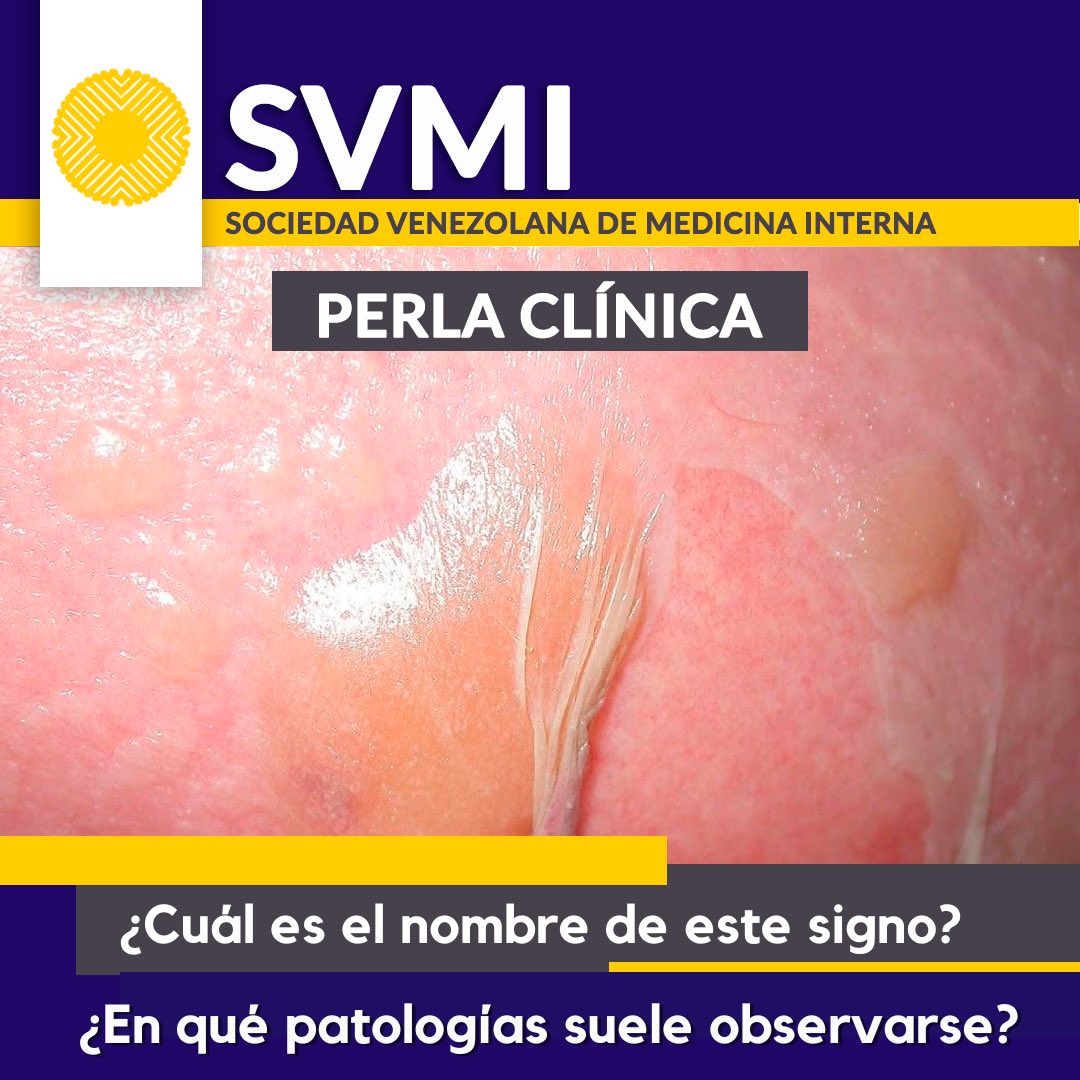 Perlas clinicas 🔥 

Cuéntanos: 

✅¿cuál es el nombre del signo que se ve en esta imagen❓ 
✅¿A cuáles patologías suele asociarse❓ 

Estaremos publicando respuesta + cápsula informativa este domingo 👀✅

¡Mantente atento para más posts como este! 🤩 

#SVMI #MedicinaInterna